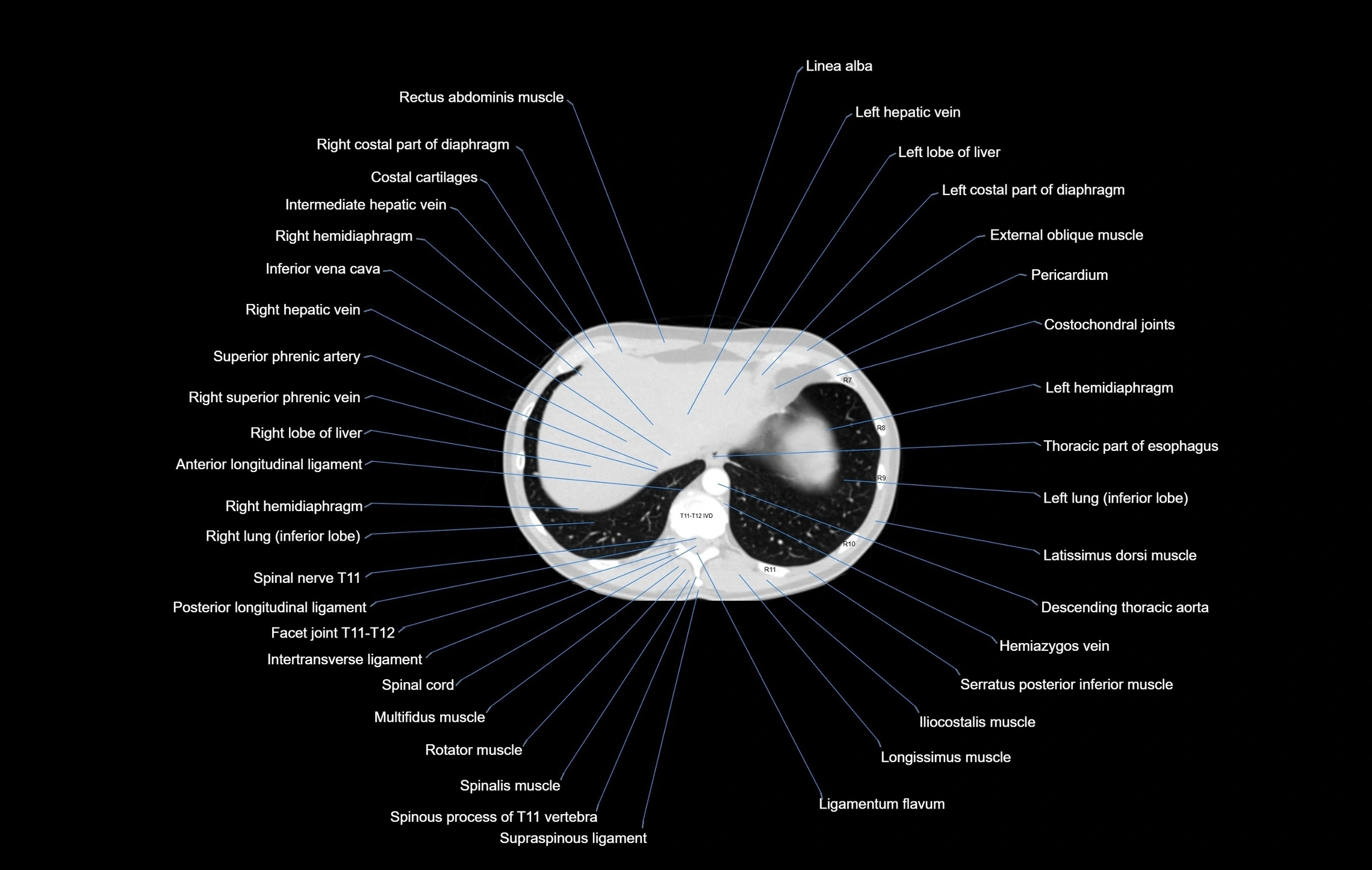 CT chest (thorax) labelled axial cross sectional anatomy radiology image-00103.webp